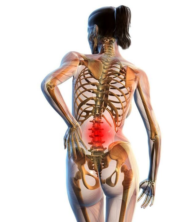 Osteochondrose der Lendenwirbelsäule kommt häufiger vor