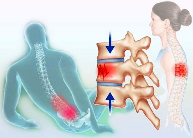 Schon eine normale Verletzung kann die Entstehung einer Osteochondrose auslösen