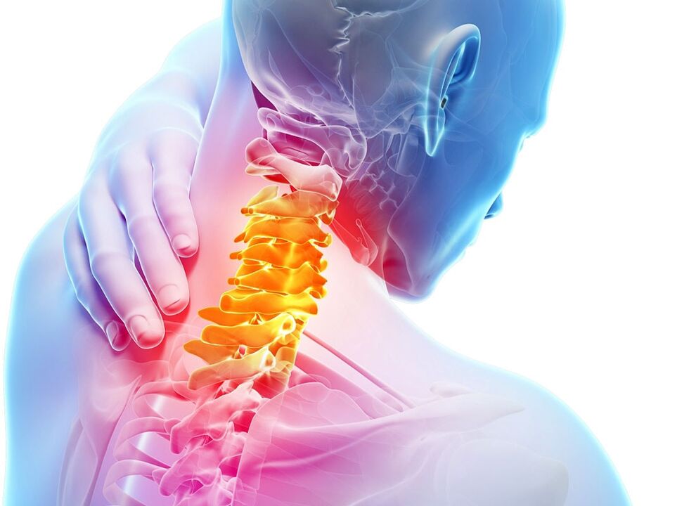 Symptome einer zervikalen Osteochondrose
